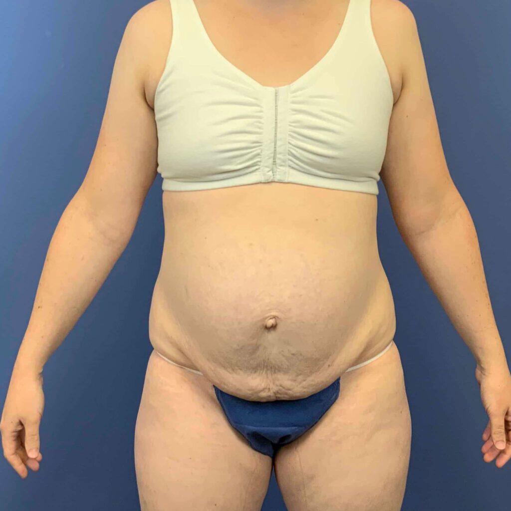 Before Image: Patient 43431 - front