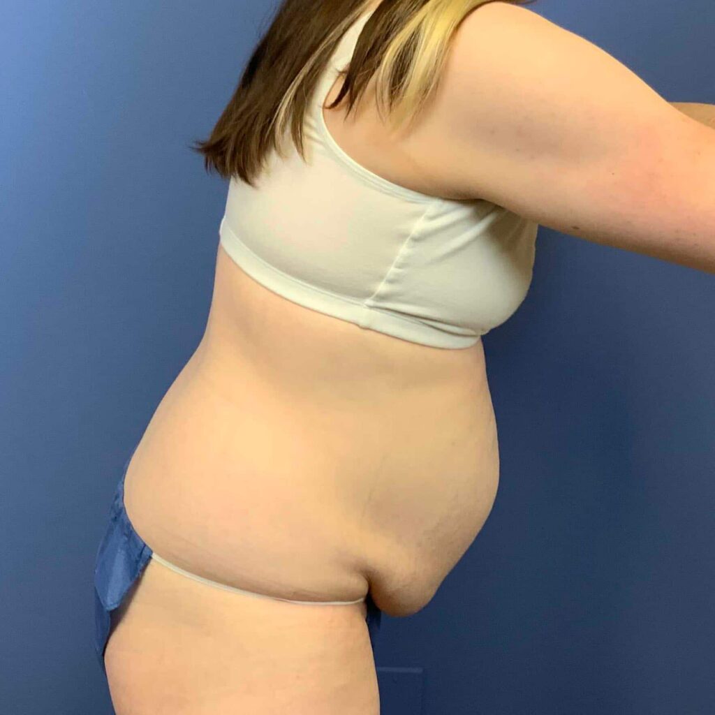 Before Image: Patient 43431 - right-side