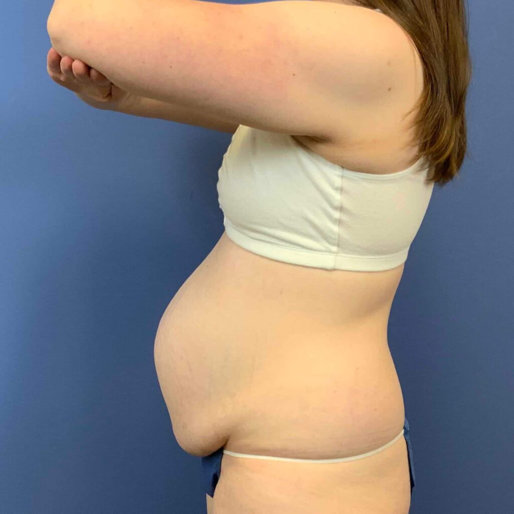 Before Image: Patient 43431 - left-side