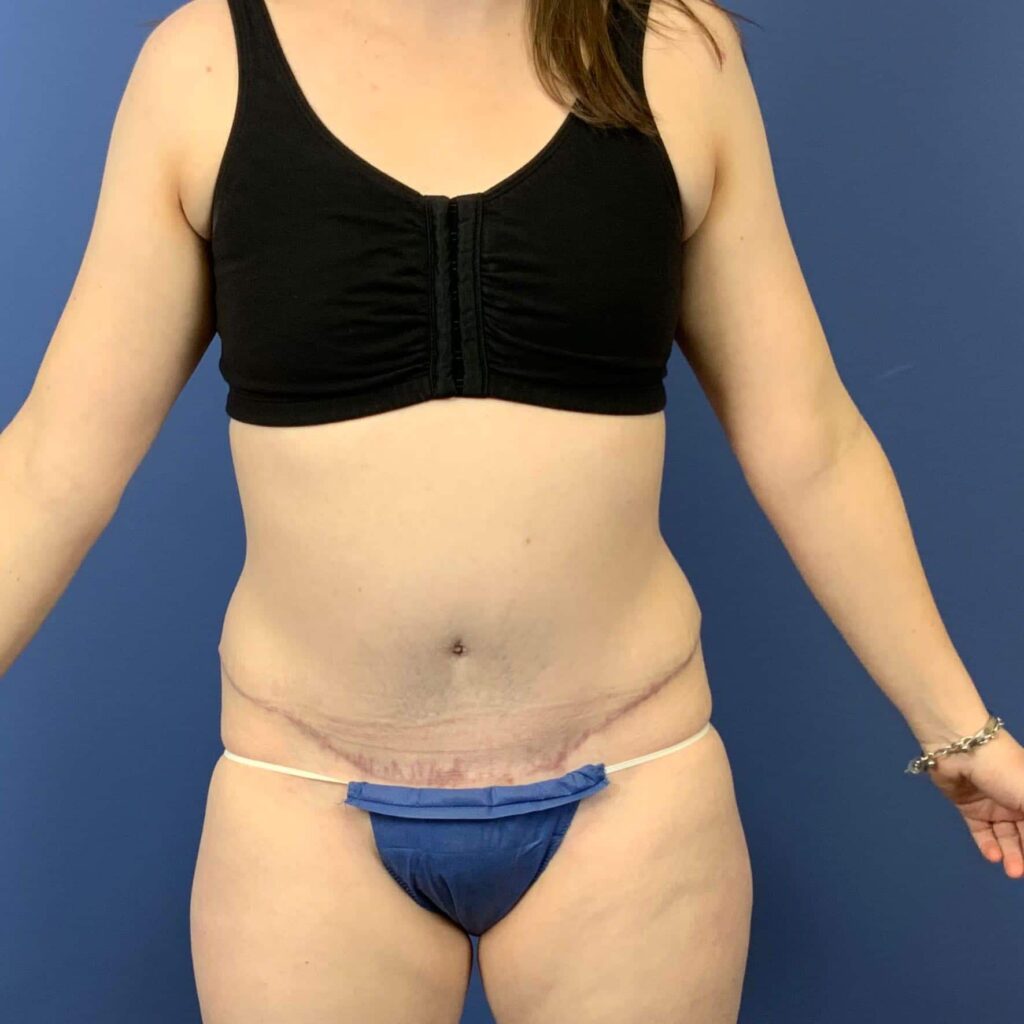 After Image: Patient 43431 - front