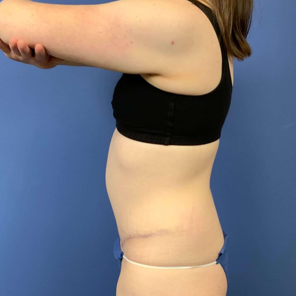 After Image: Patient 43431 - left-side