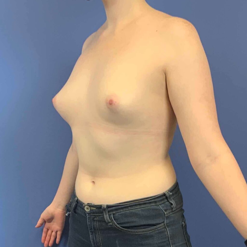 Before Image: Patient 43546 - front