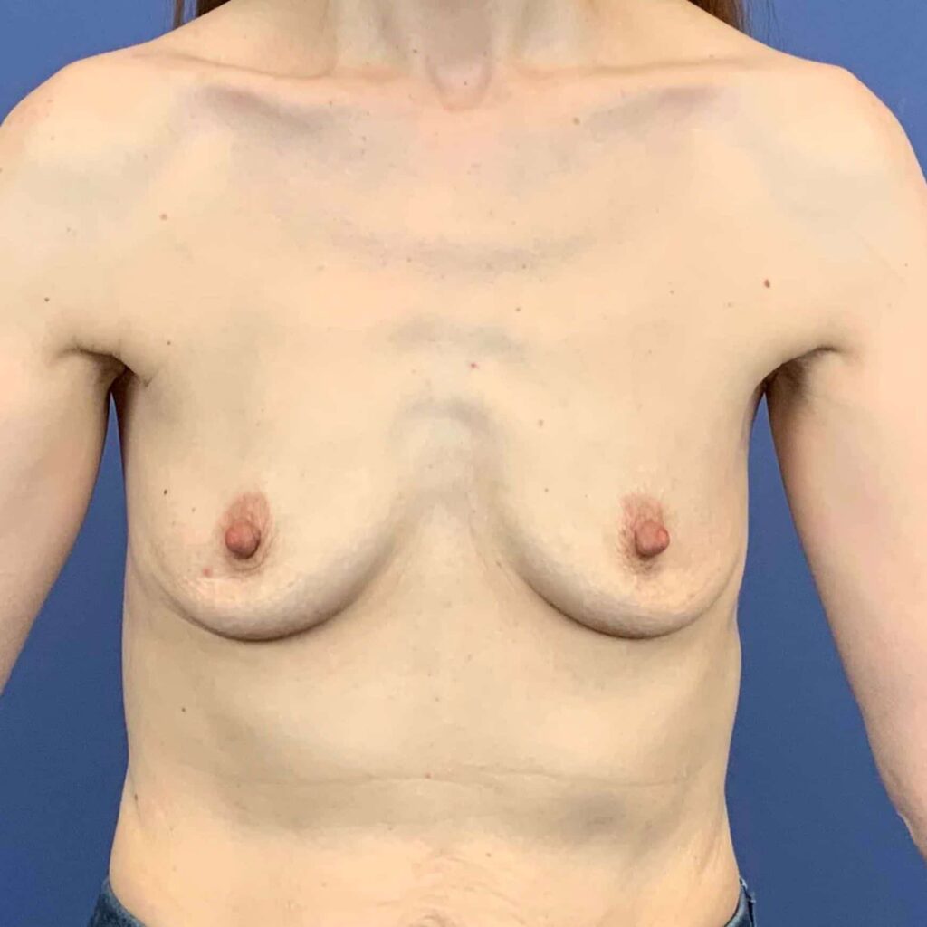 Before Image: Patient 43377 - front