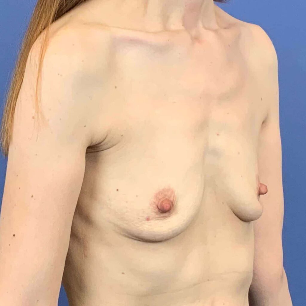 Before Image: Patient 43377 - right-front-oblique