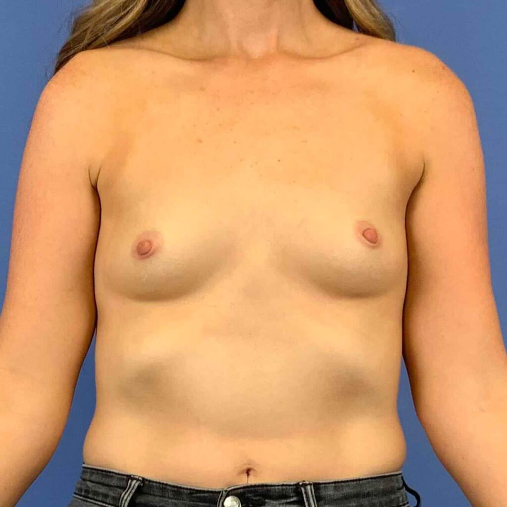 Before Image: Patient 43398 - front