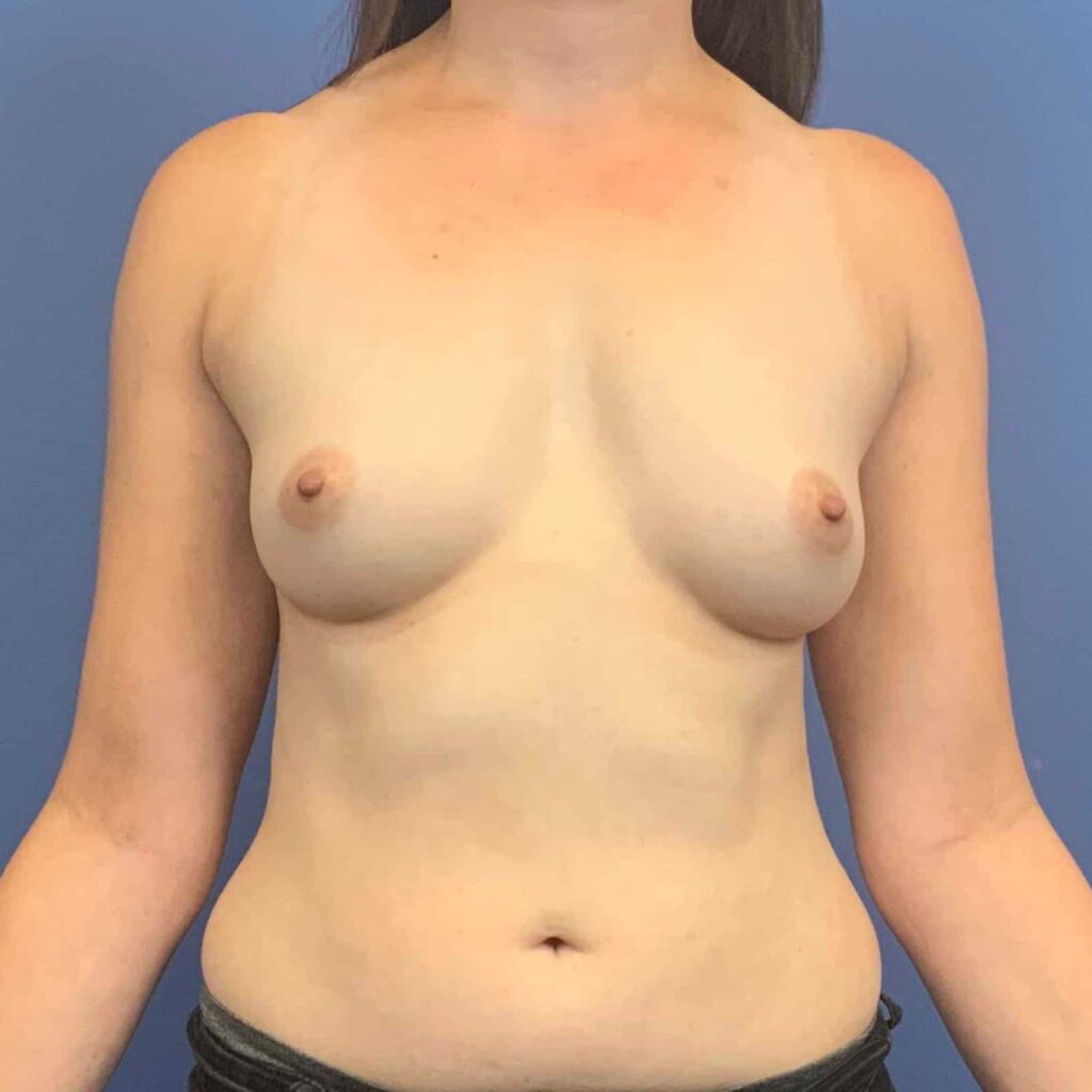 Before Image: Patient 34348 - front