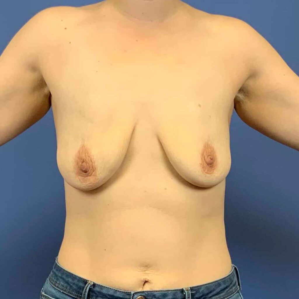 Before Image: Patient 43511 - front