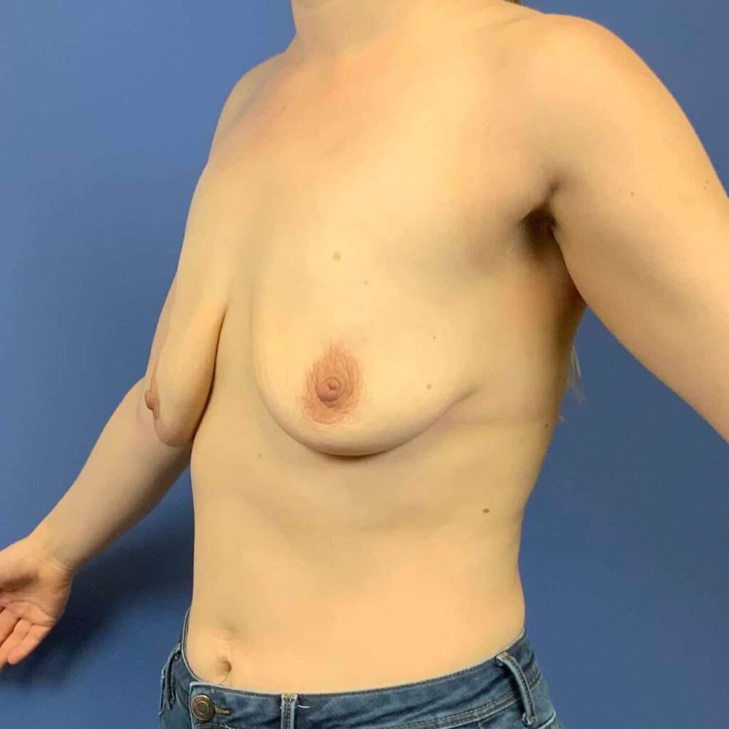 Before Image: Patient 43511 - left-front-oblique