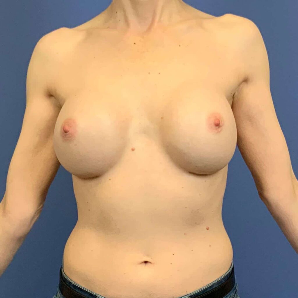 Before Image: Patient 43525 - front