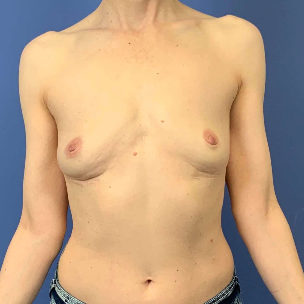 After Image: Patient 43525 - front