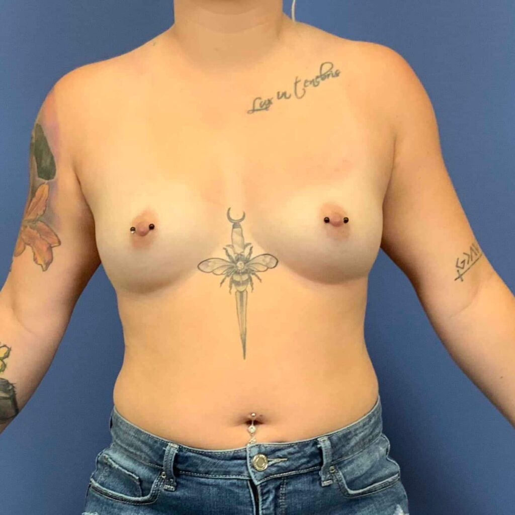 Before Image: Patient 43560 - front