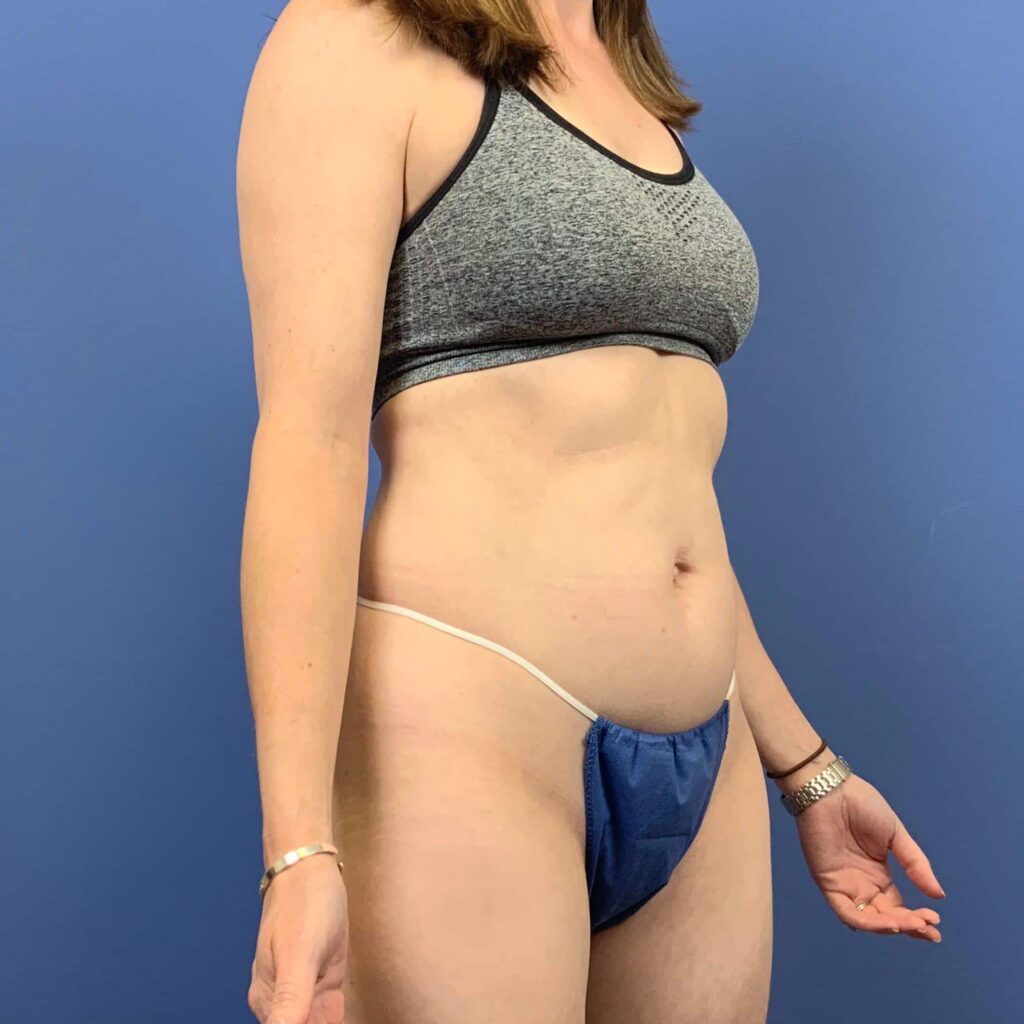 After Image: Patient 43553 - right-front-oblique