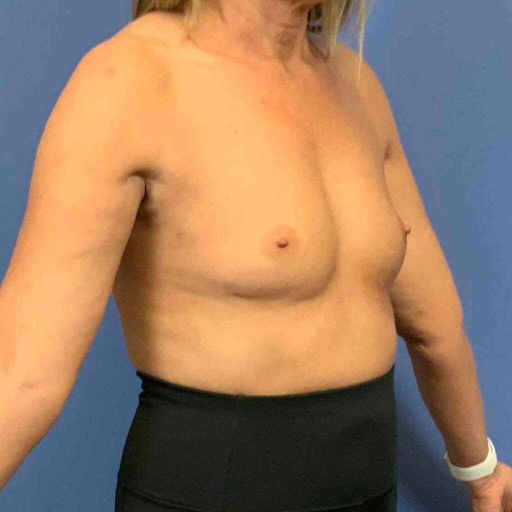 Before Image: Patient 43492 - right-front-oblique