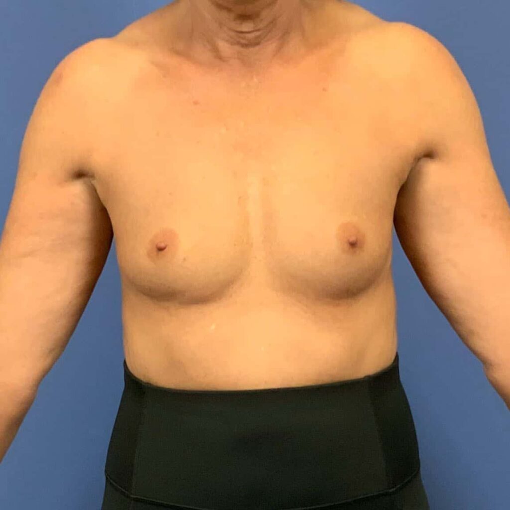Before Image: Patient 43492 - front