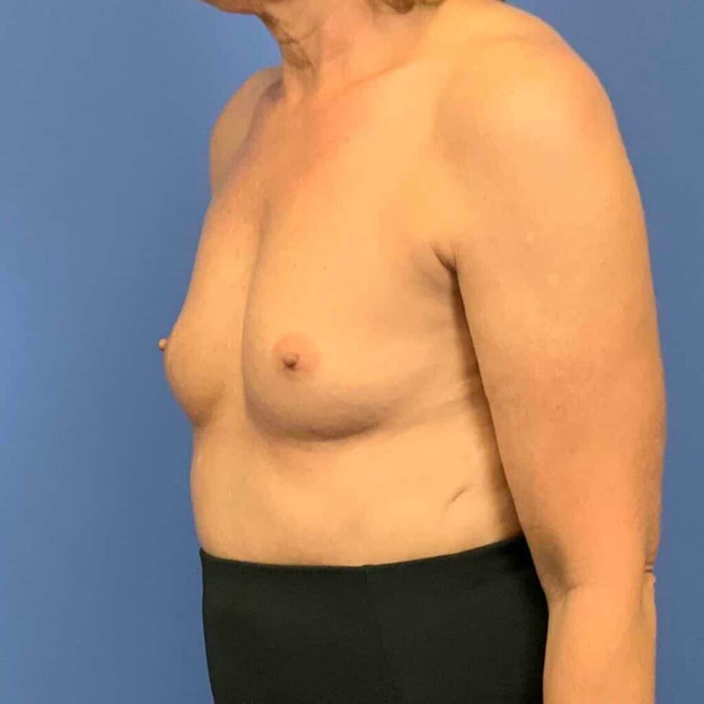 Before Image: Patient 43492 - left-front-oblique
