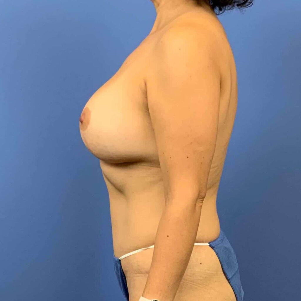 After Image: Patient 43370 - left-side