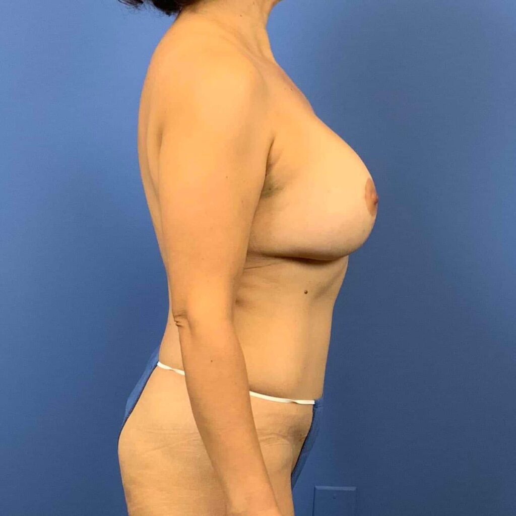 After Image: Patient 43370 - right-side