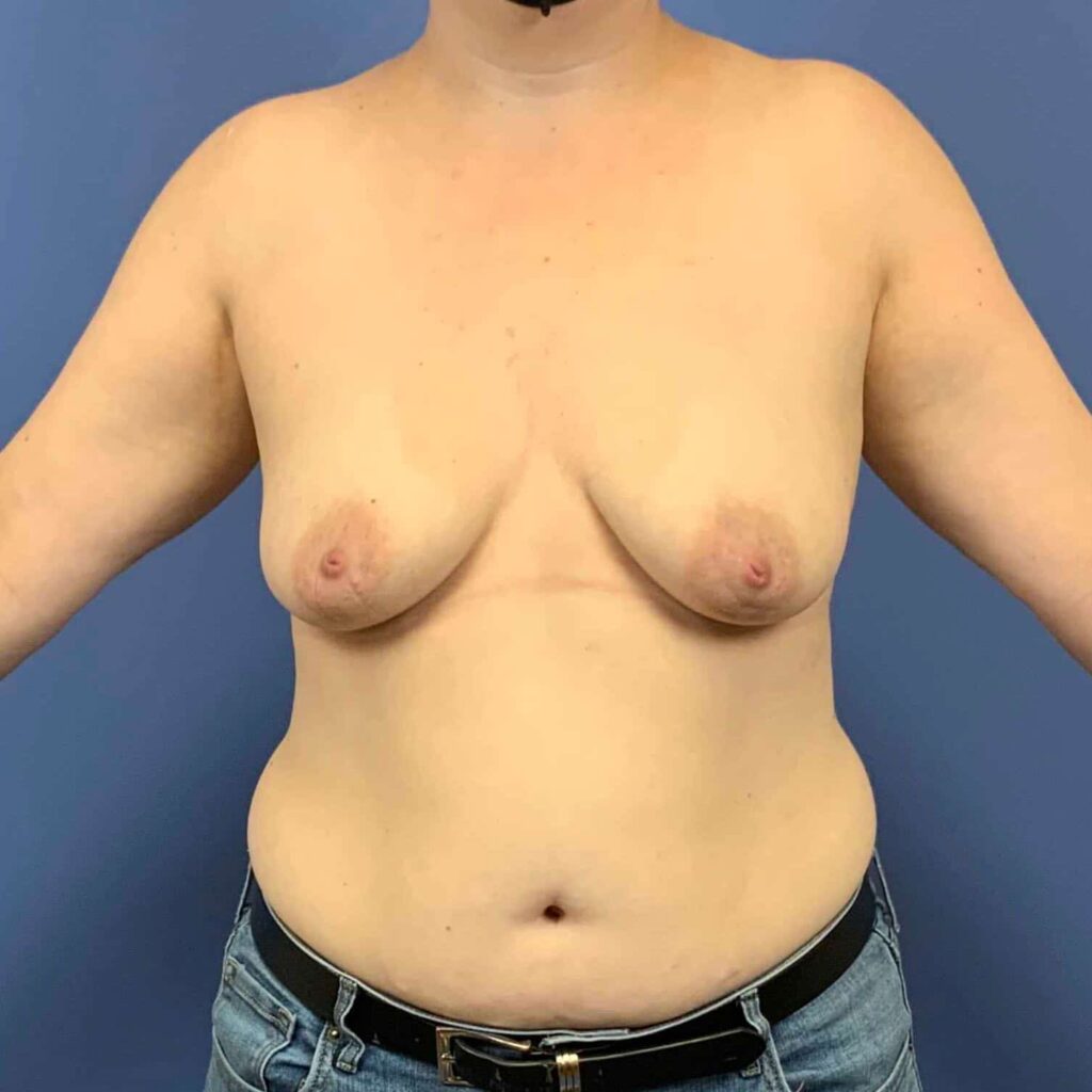 Before Image: Patient 43535 - front