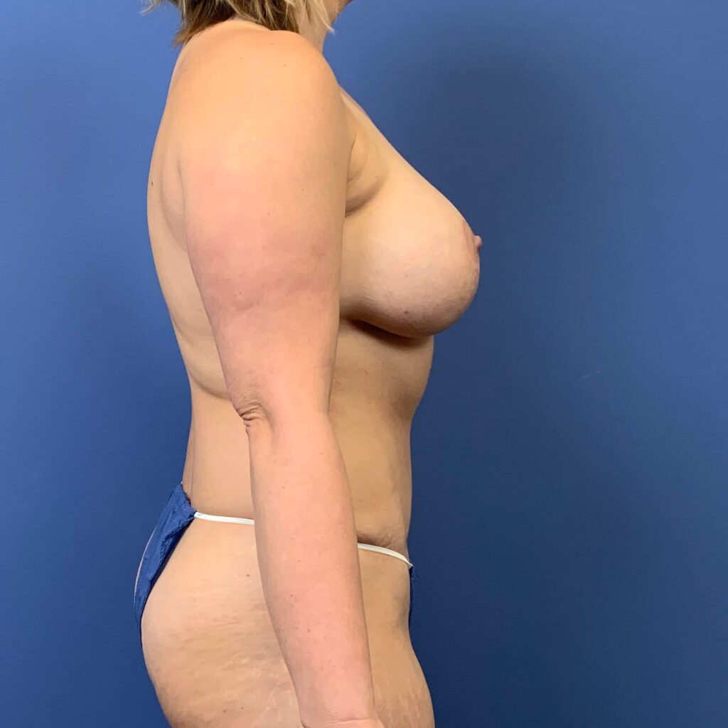 After Image: Patient 43478 - right-side