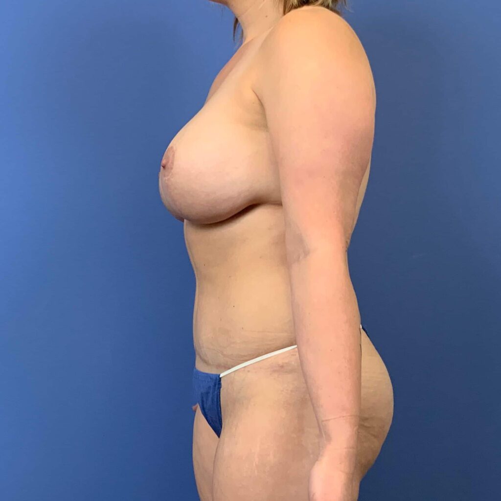 After Image: Patient 43478 - front