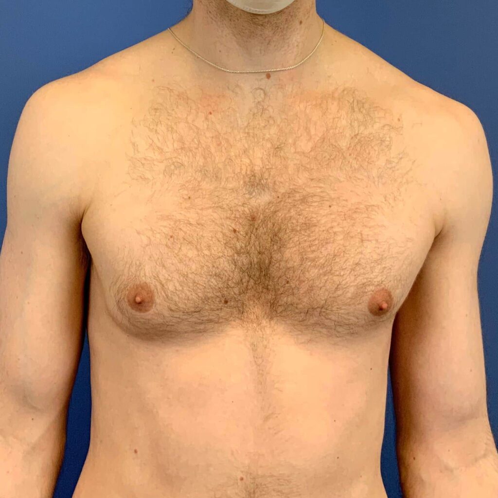 Before Image: Patient 43572 - front