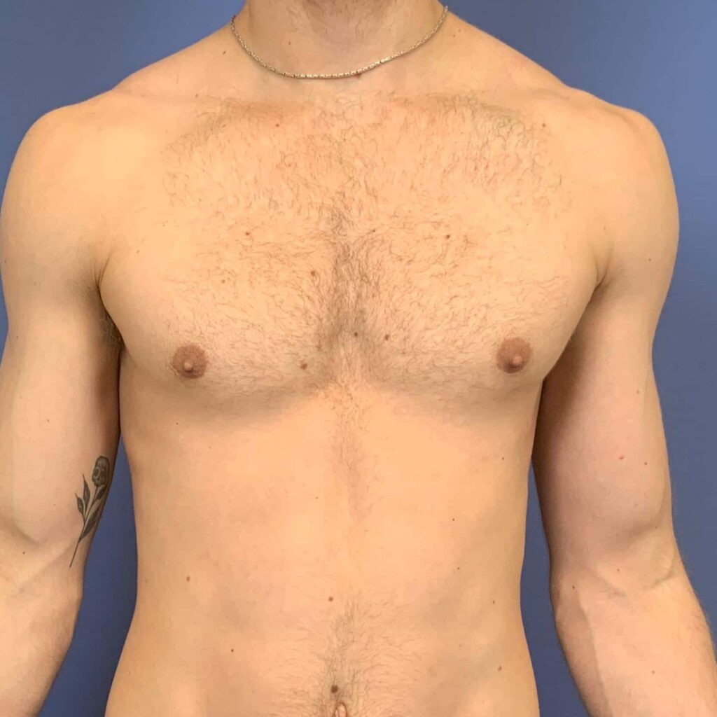 After Image: Patient 43572 - front