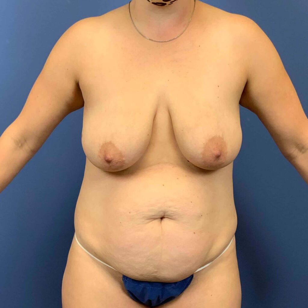 Before Image: Patient 43424 - front