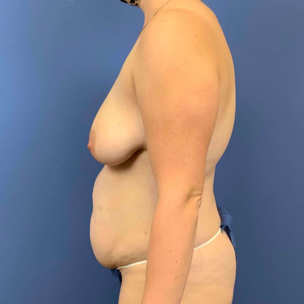 Before Image: Patient 43424 - left-side