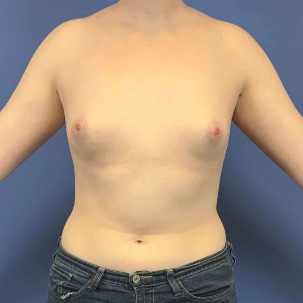 Before Image: Patient 43546 - front