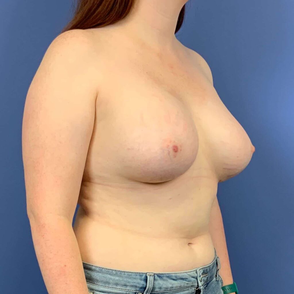 After Image: Patient 43546 - right-front-oblique