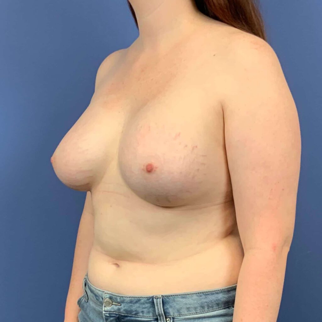 After Image: Patient 43546 - front