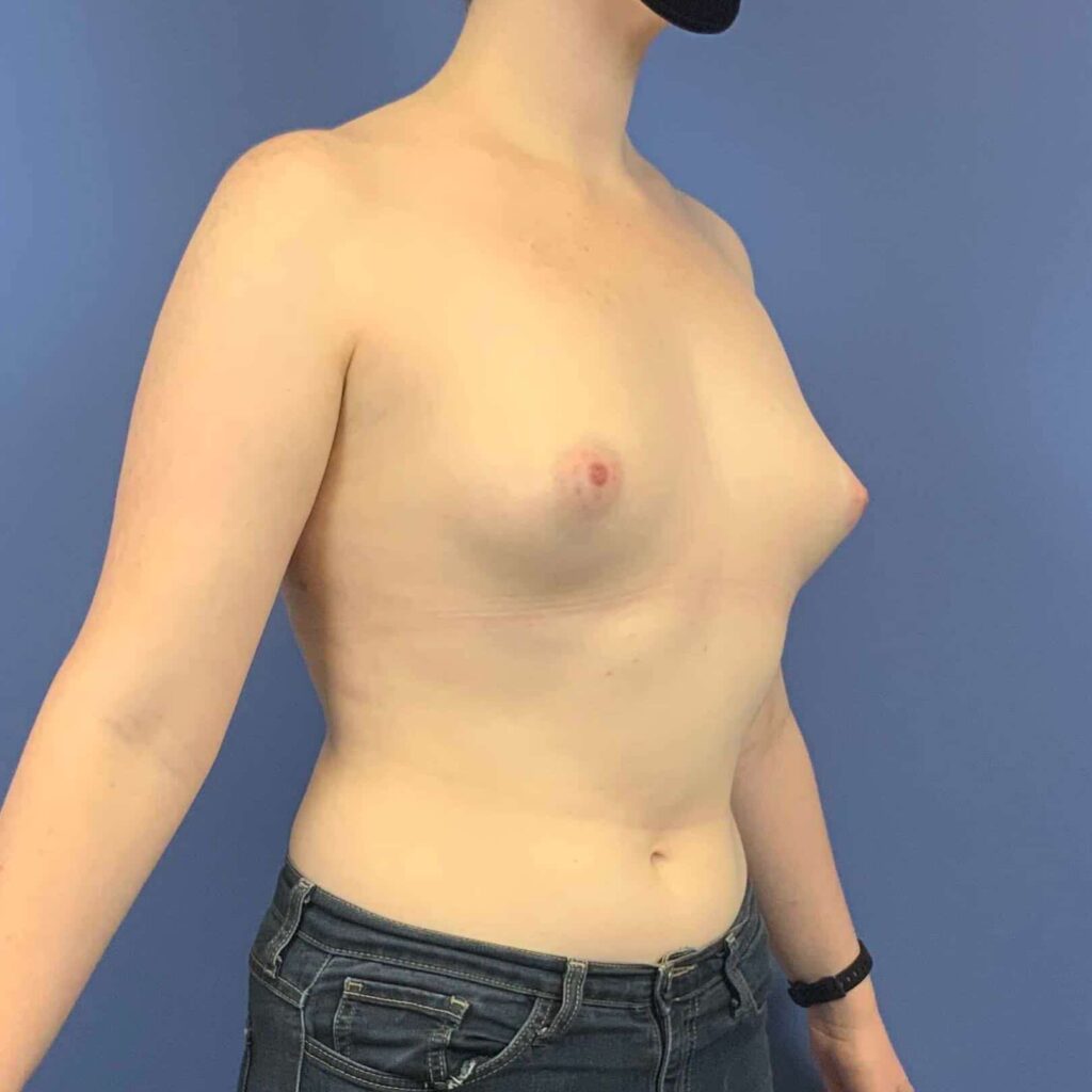 Before Image: Patient 43546 - right-front-oblique