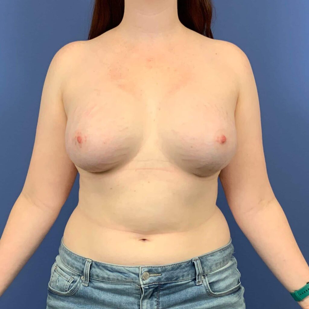 After Image: Patient 43546 - front