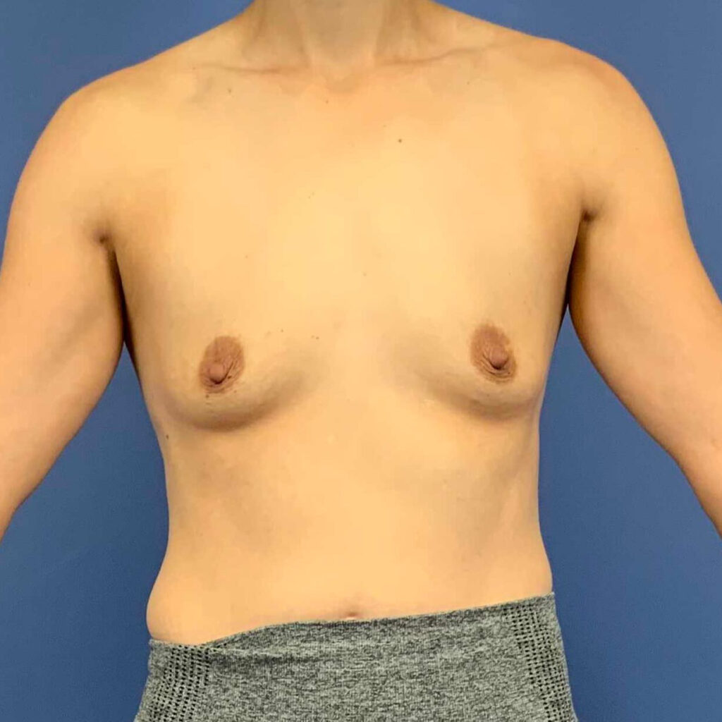 Before Image: Patient 43504 - front