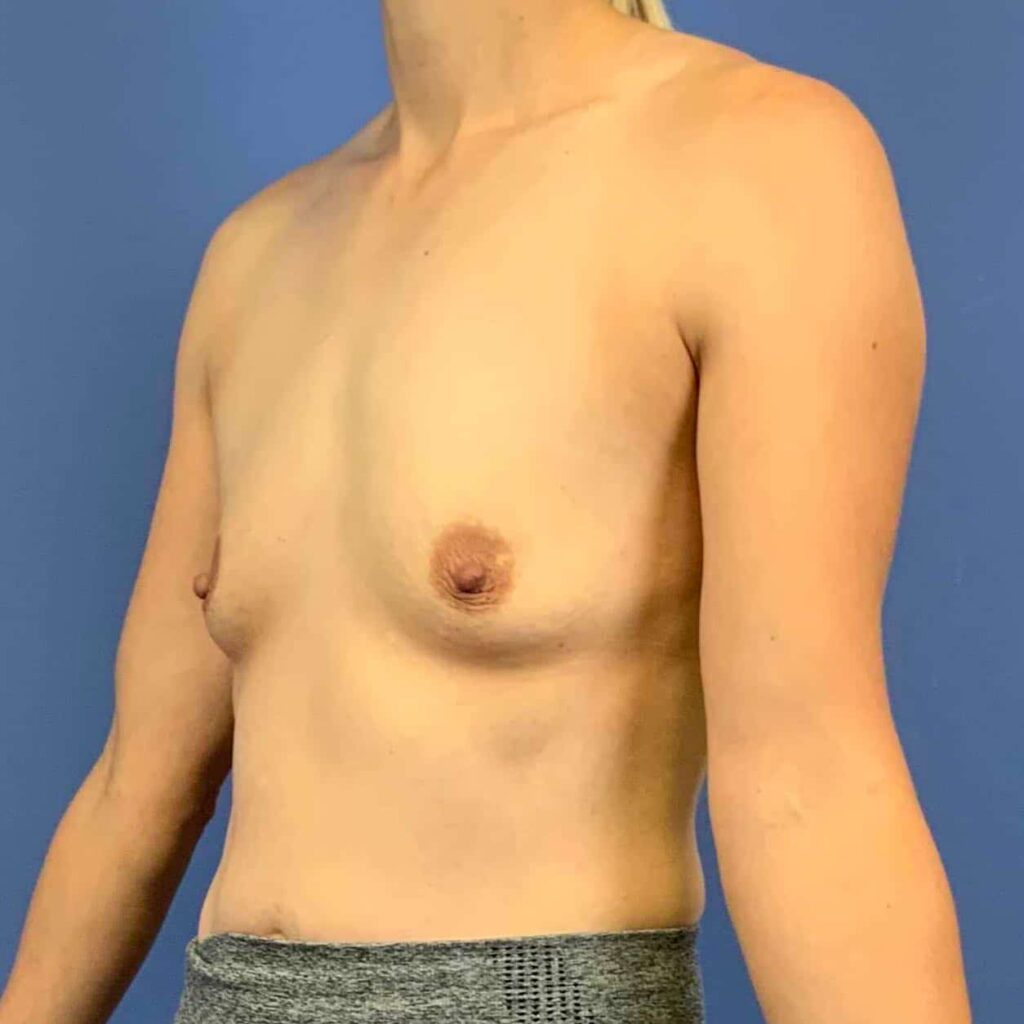 Before Image: Patient 43504 - front