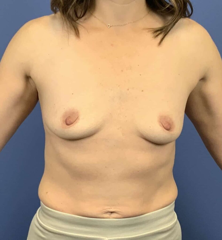 Before Image: PATIENT #43306 - front