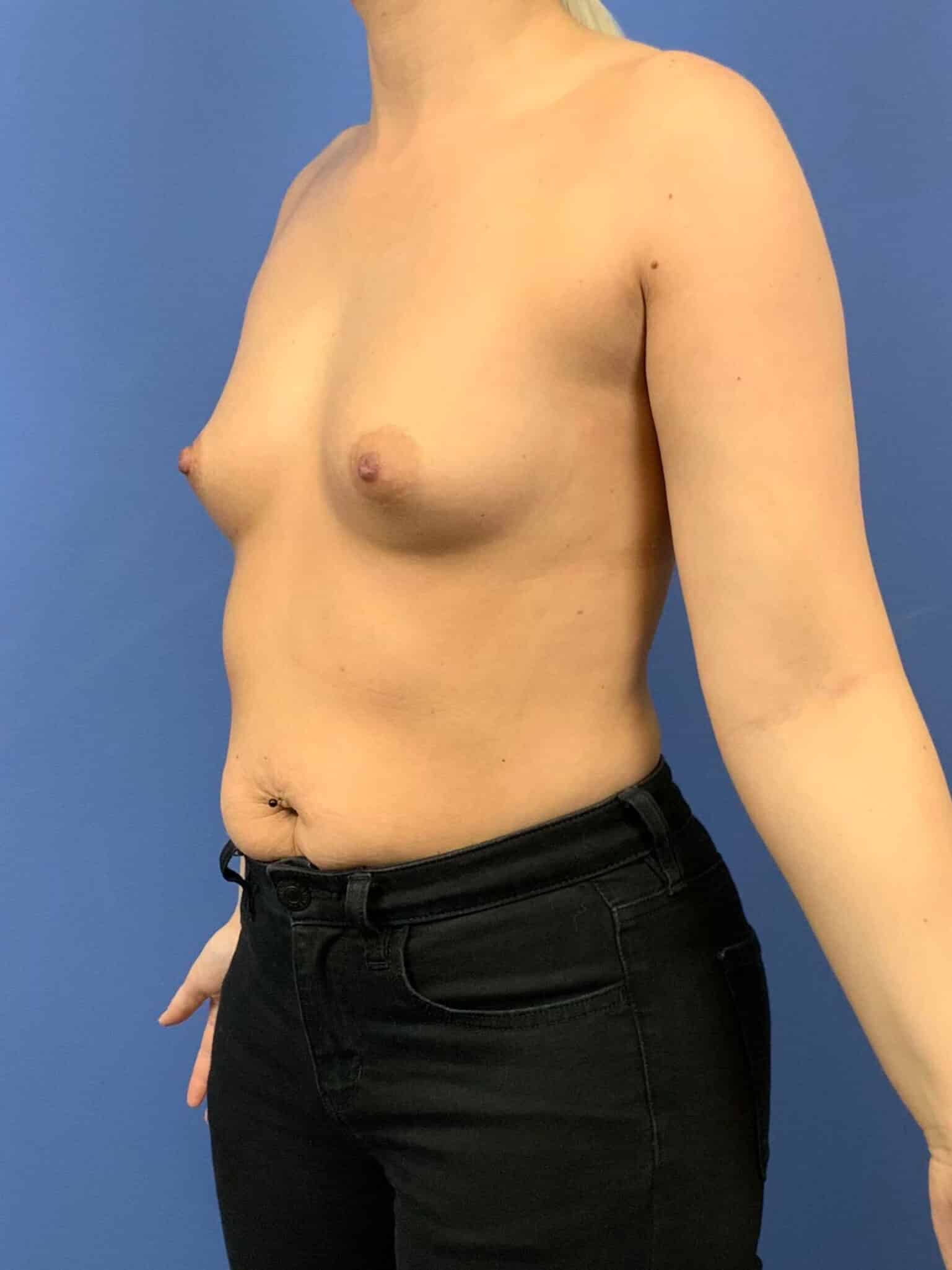 Before Image: Patient 43810 - left-front-oblique