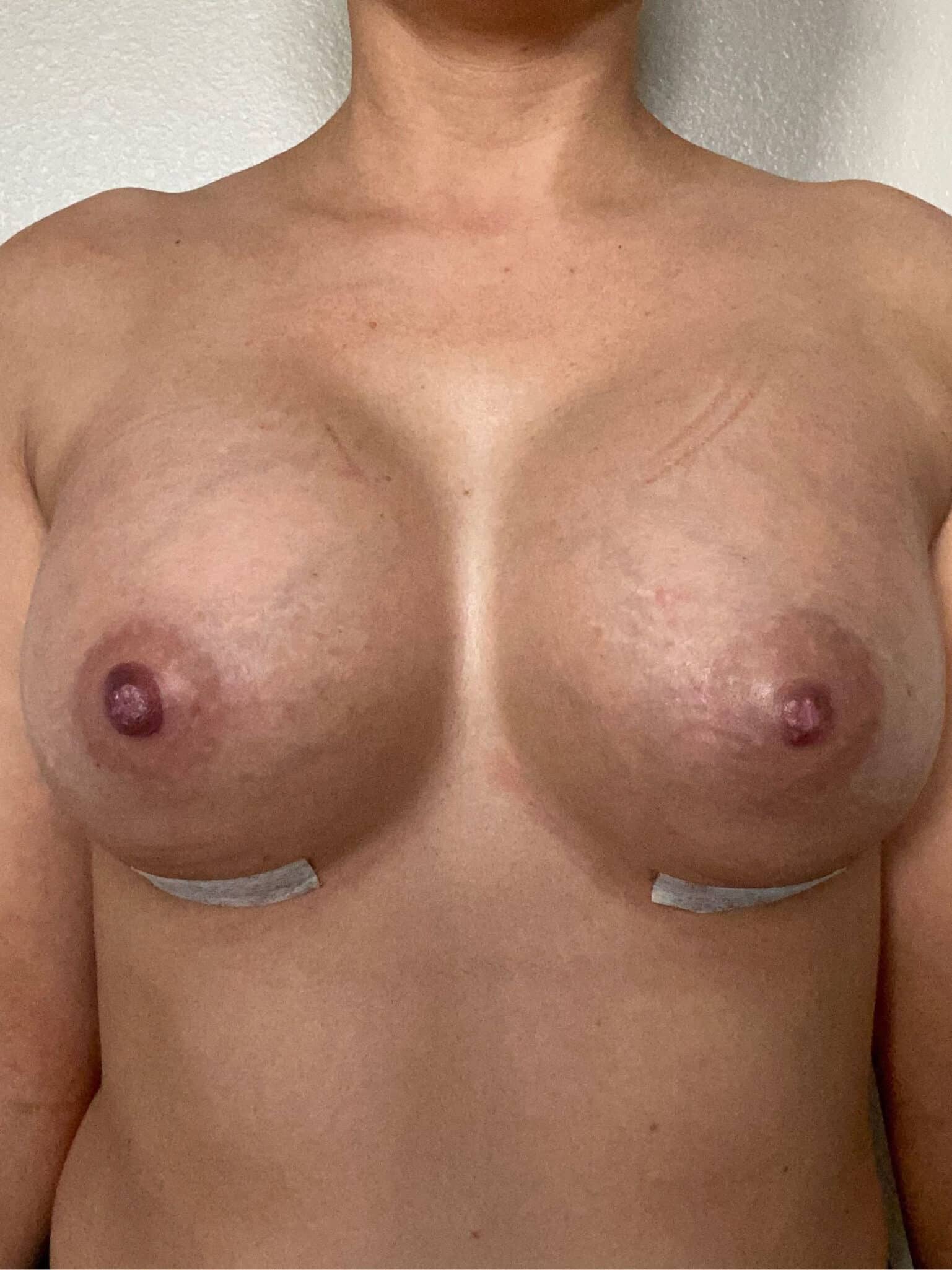 Before Image: Patient 43810 - front