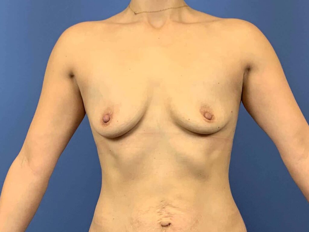 Before Image: Patient  43825 - front