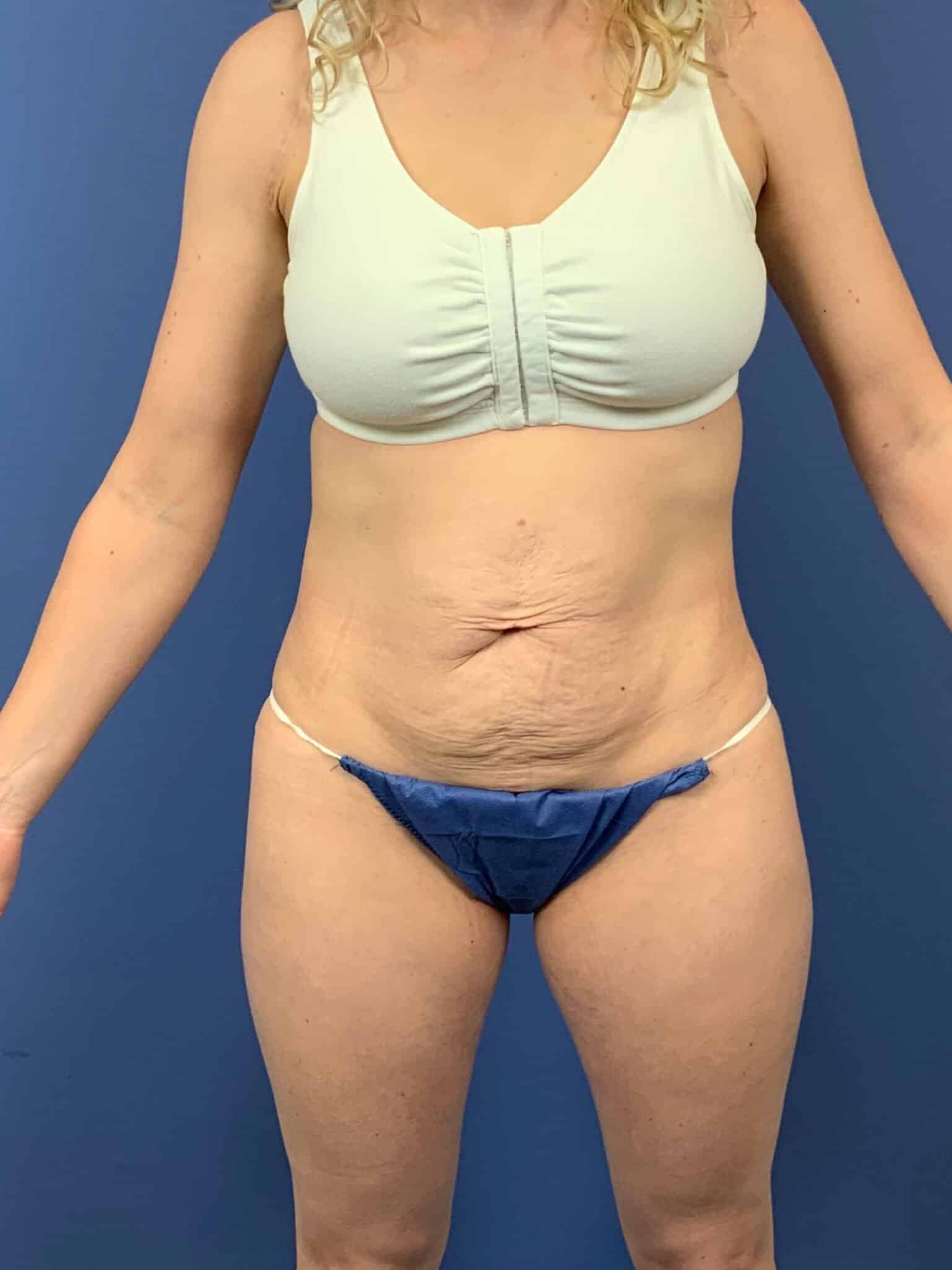Before Image: Patient 43798 - front