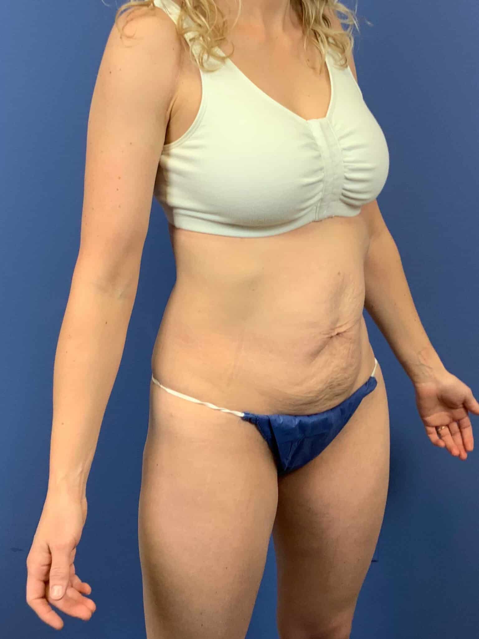 Before Image: Patient 43798 - right-front-oblique