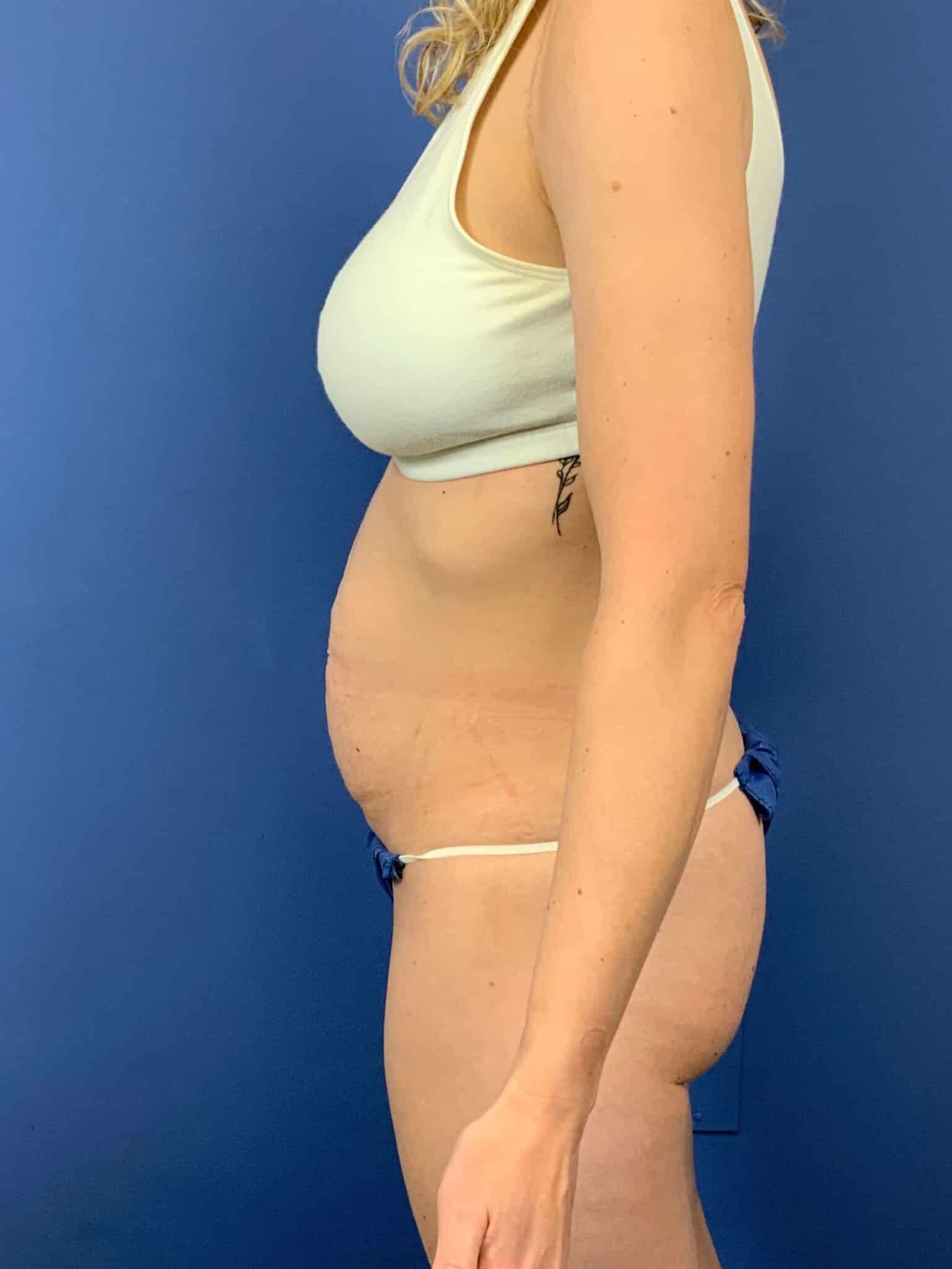Before Image: Patient 43798 - left-side