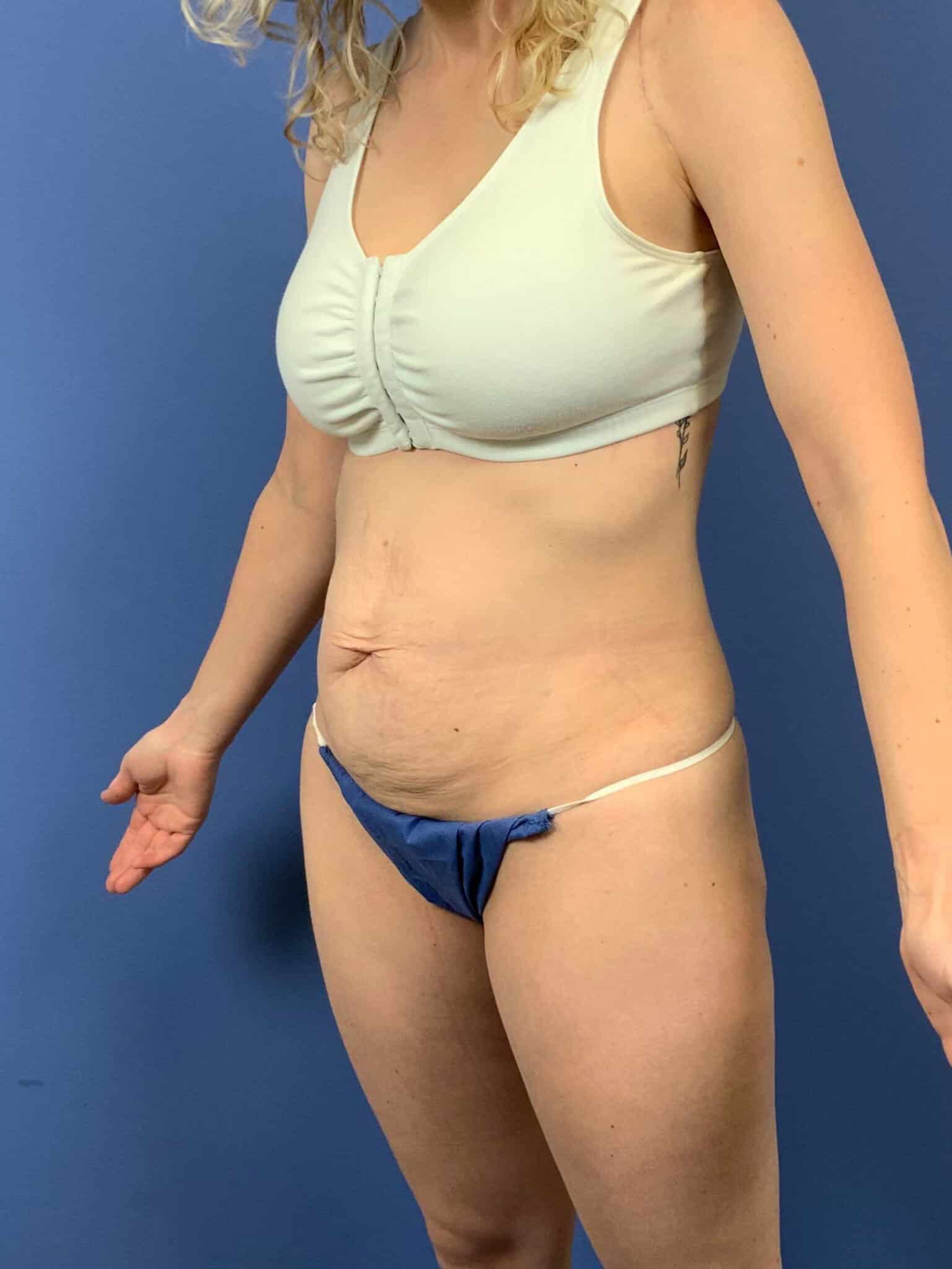 Before Image: Patient 43798 - left-front-oblique