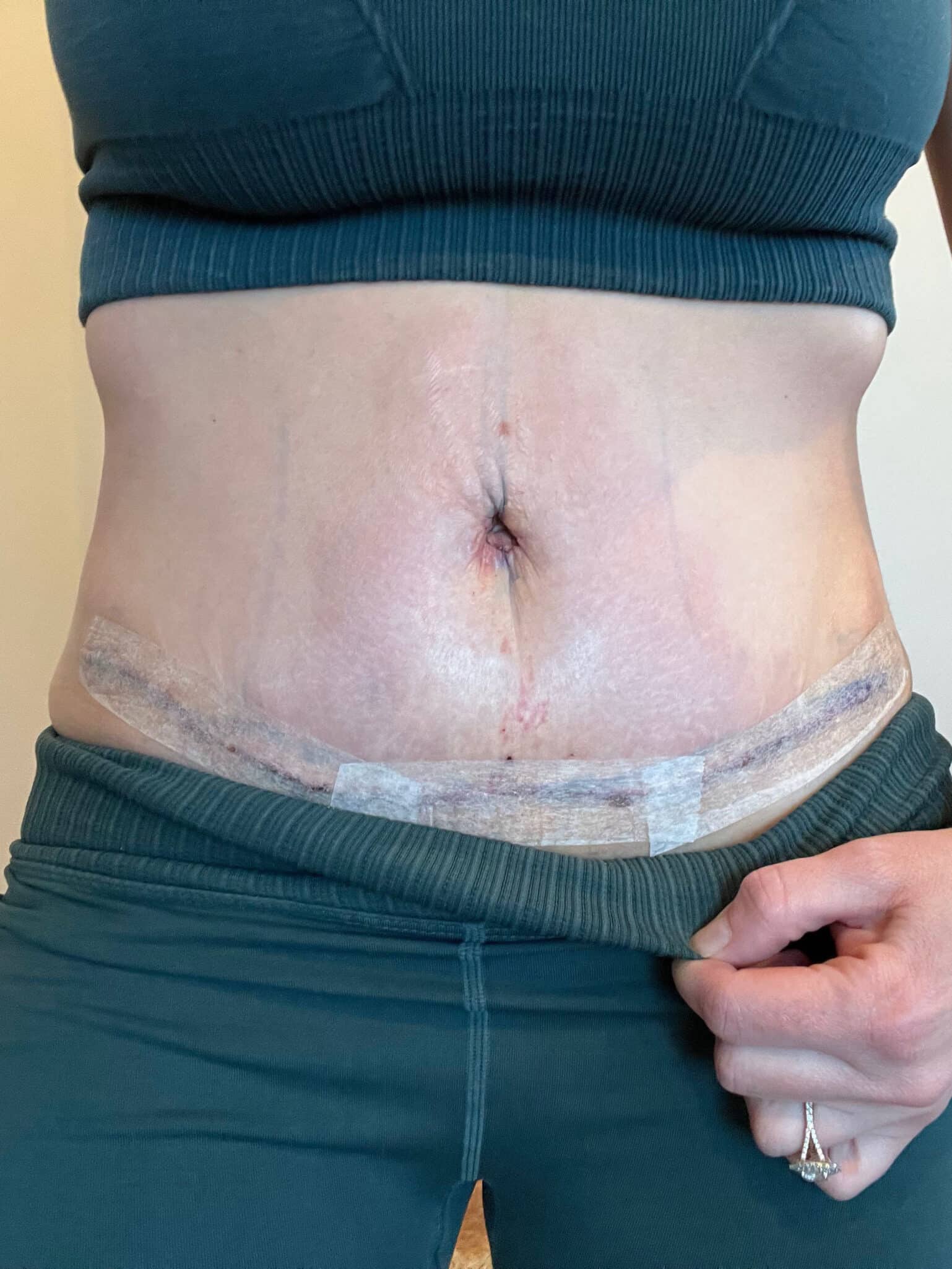 After Image: Patient 43798 - front