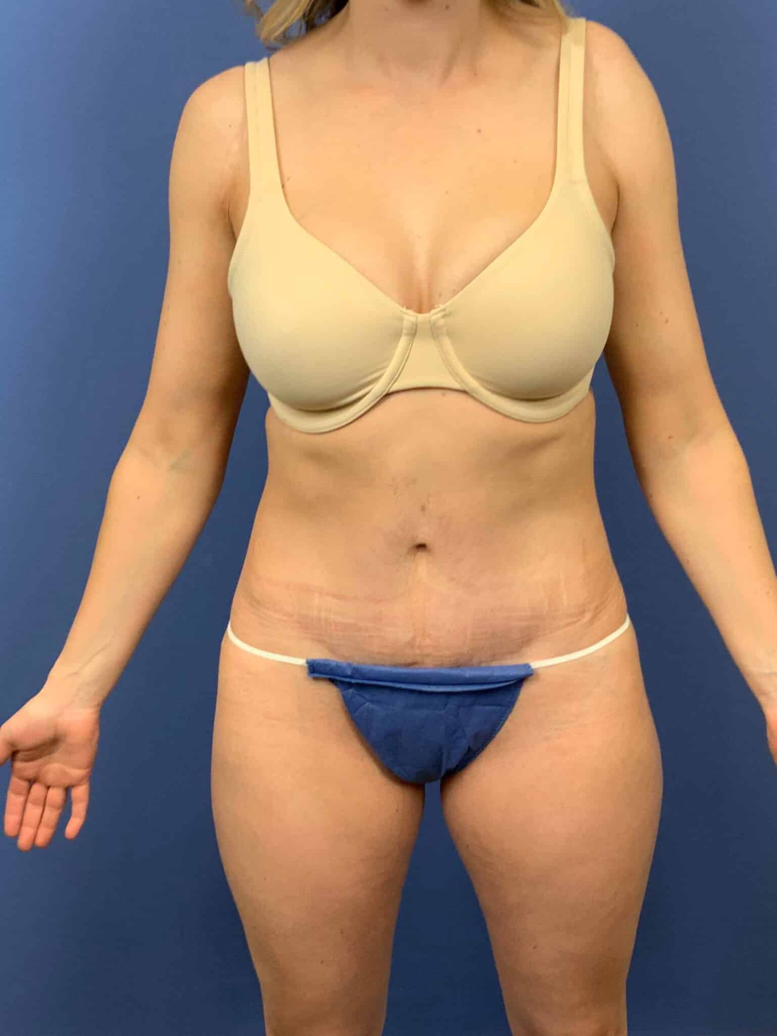 After Image: Patient 43798 - front
