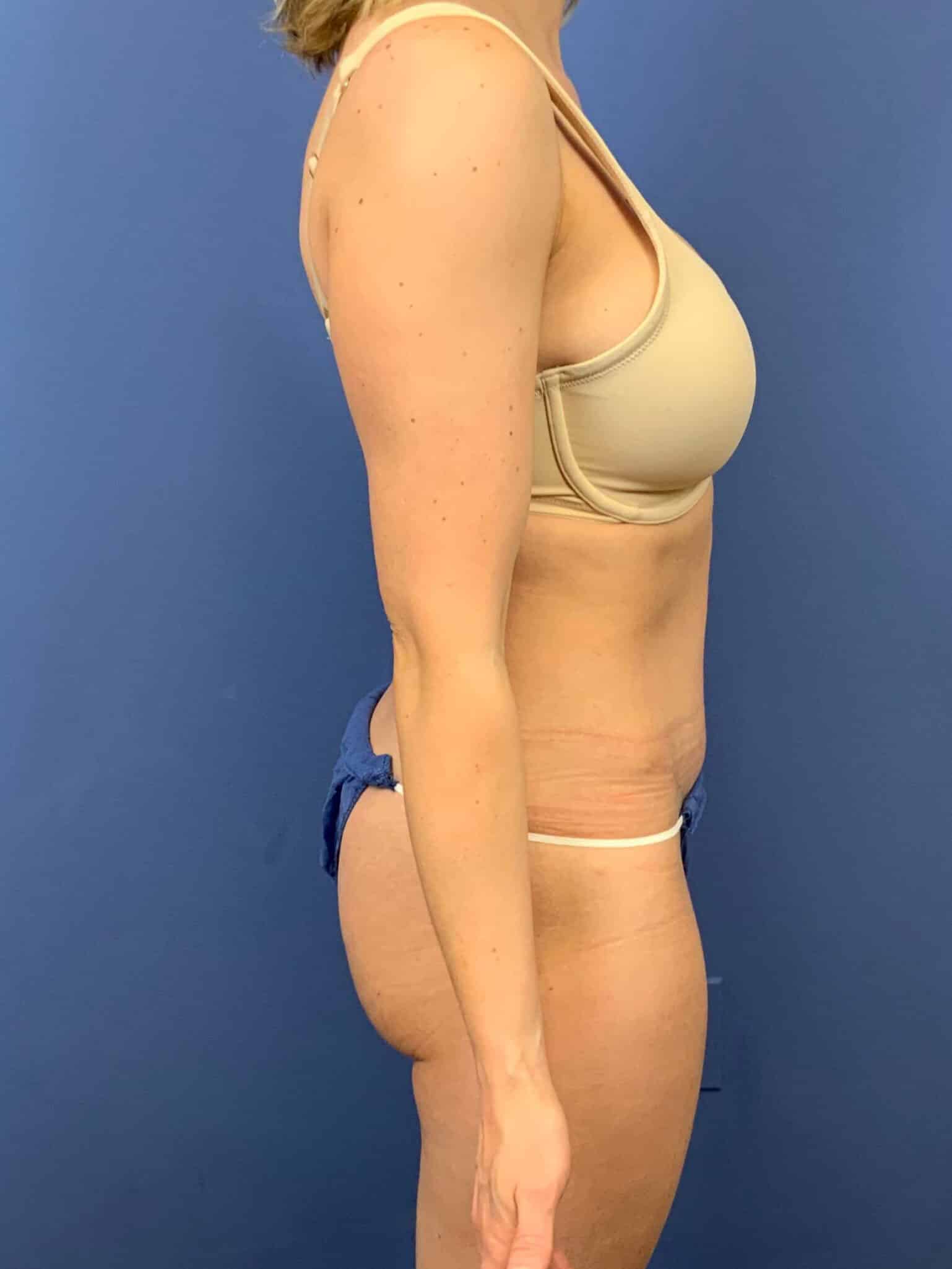 After Image: Patient 43798 - right-side