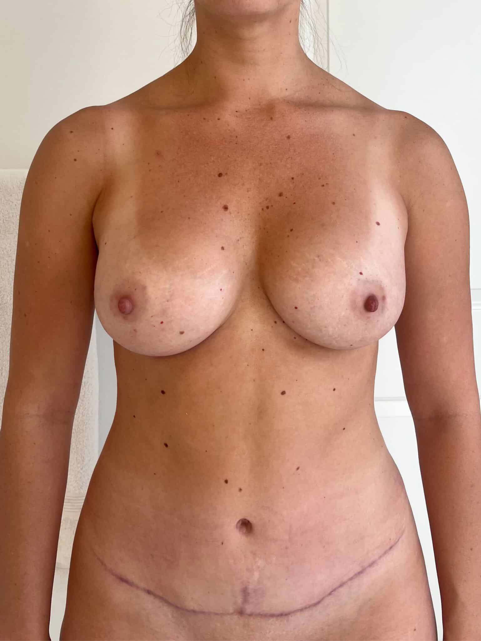 After Image: Patient #43755 - front