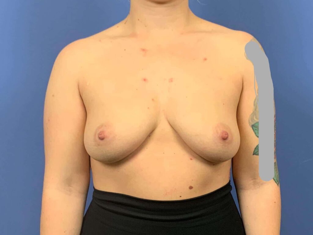 Before Image: Patient 43834 - front