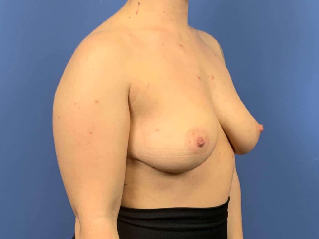 Before Image: Patient 43834 - right-front-oblique