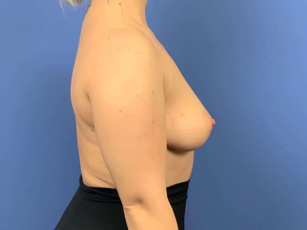 Before Image: Patient 43834 - right-side
